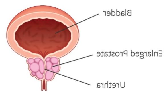 Enlarged prostate graphic